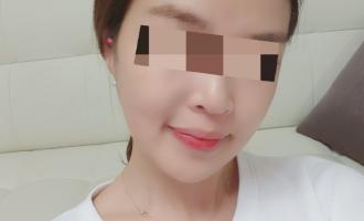 노원점미앤미에서 턱보톡스+여우주사 맞았어요!!