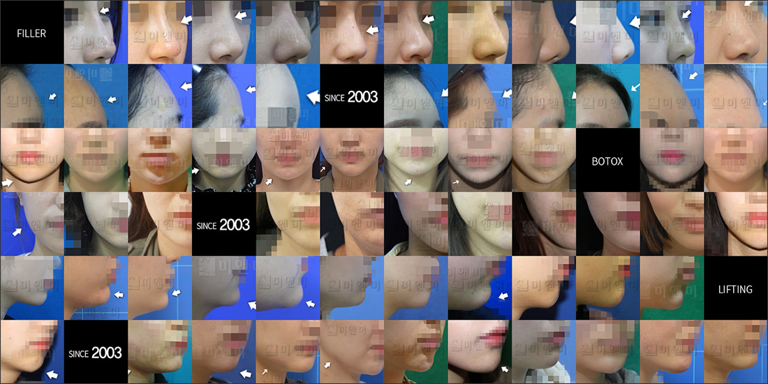 SINCE 2003 MI&MI, 시술후사진모음 강남V라인주사, 강남역V라인주사, 강남윤곽주사, 강남역윤곽주사, 강남라인주사, 강남역라인주사, 강남사각턱보톡스, 강남역사각턱보톡스, 강남턱보톡스, 강남역보톡스