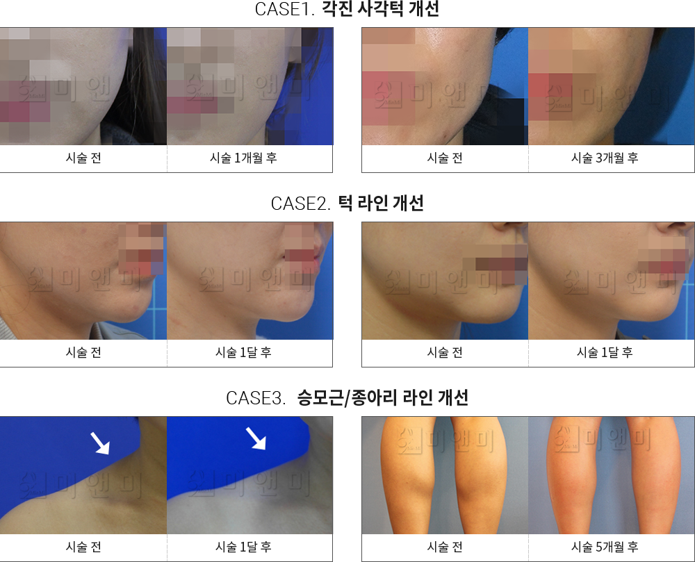 시술전후사진 승모근 보톡스 : 각진 사각턱 개선,턱 라인 개선,승모근/종아리 라인 개선 승모근보톡스 - 강남 미앤미 의원