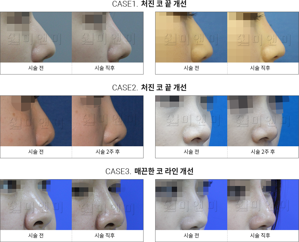 시술전후사진 미앤코 : 처진 코 끝 개선, 매끈한 코라인 개선 미앤코 - 강남 미앤미 의원