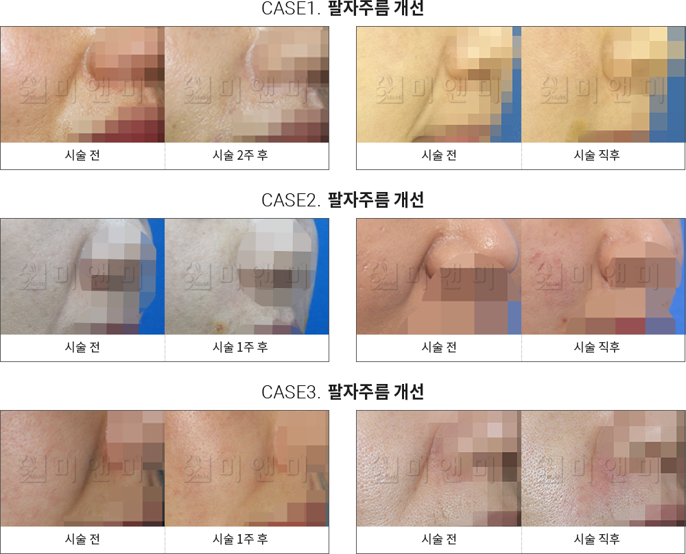 시술전후사진 팔자필러 : 팔자주름 개선 팔자주름필러 - 강남 미앤미 의원