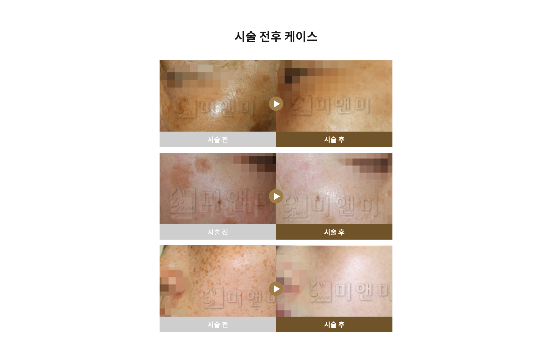 시술 전후 케이스 듀얼스팟레이저